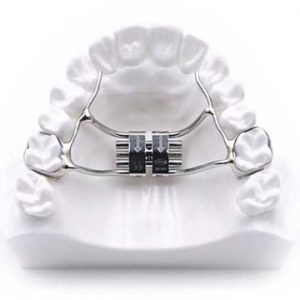 Teeth Straightening Gold Coast, Palatal Expander For Adults Teeth